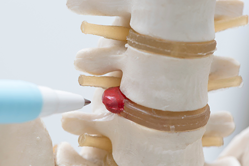 Life Chiropractic & Acupuncture - Disc Herniation