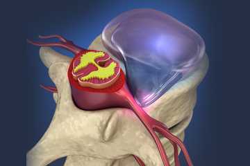 Disc Herniation and a Disc Bulge
